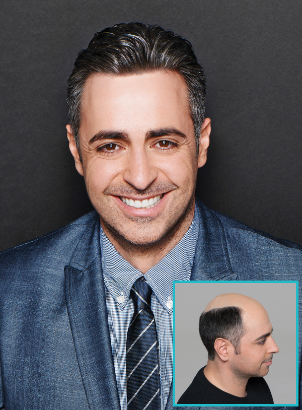 Elite Hair Loss Solutions